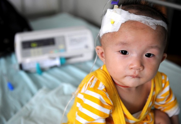 
Un copil care suferă de pietre la rinichi după ce a băut lapte praf contaminat, primeşte tratament intravenos la Spitalul de Copii din Chengdu la 22 septembrie 2008, în Chengdu, provincia Sichuan, China.
