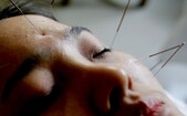 Acupunctură (China Photos/Getty Images)