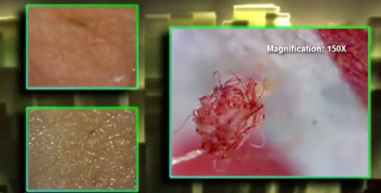 Cazuri ale sindromului Morgellon (Capturi youtube)