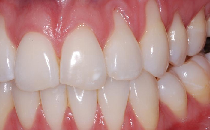 antiinflamatoare naturale pentru dinti