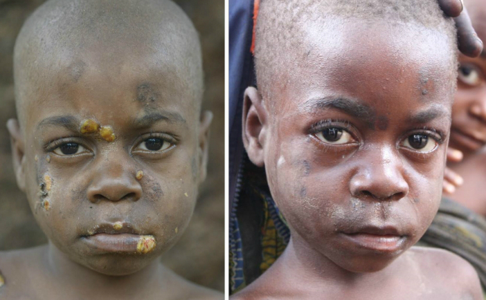 Un copil Aka, înainte a şi după tratamentul împotriva bolii Framboesia (foto: Hien Lam Duc / MSF)