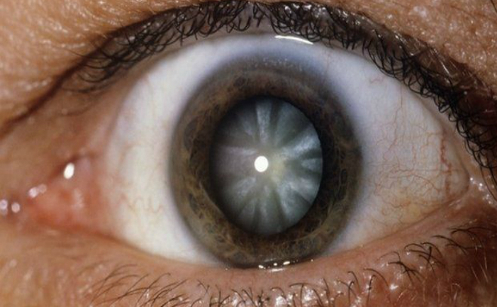 Cataracta, o boală care atacă ochiul şi se manifestă prin opacifierea cristalinului sau a capsulei lui (Captură web)