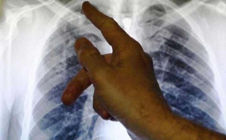 Scanare cu raze X a unui pacient cu tuberculoză. (Captură Foto)