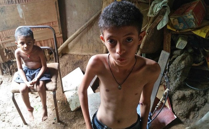 Drama malnutriţiei infantile severe din Venezuela (captură video)
