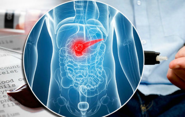 Cancerul pancreatic apare atunci când celulele din pancreas, un organ glandular din spatele stomacului, încep să se multiplice fără control şi formează un neoplasm. (Getty Images)