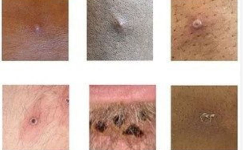 Imagini care arată exemple de erupţii şi leziuni datorate virusul variolei maimuţei