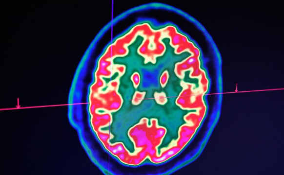În această fotografie de arhivă, o imagine a unui creier uman luată de un tomograf cu emisie de pozitroni, numit şi scanare PET, este văzută pe un ecran la Centrul spitalicesc regional şi universitar din Brest, în vestul Franţei, la 9 ianuarie 2019. (Fred Tanneau/AFP/Getty Images/EET)