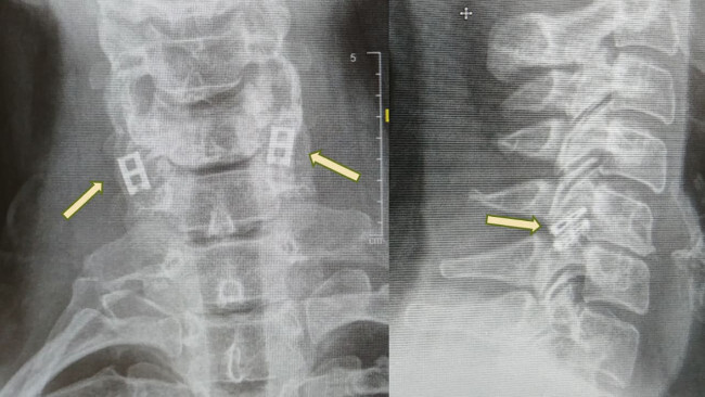 Radiografie DTRAX (Foto credit: COURTESY SAMSON ASSUTA ASHDOD MEDICAL CENTR)
